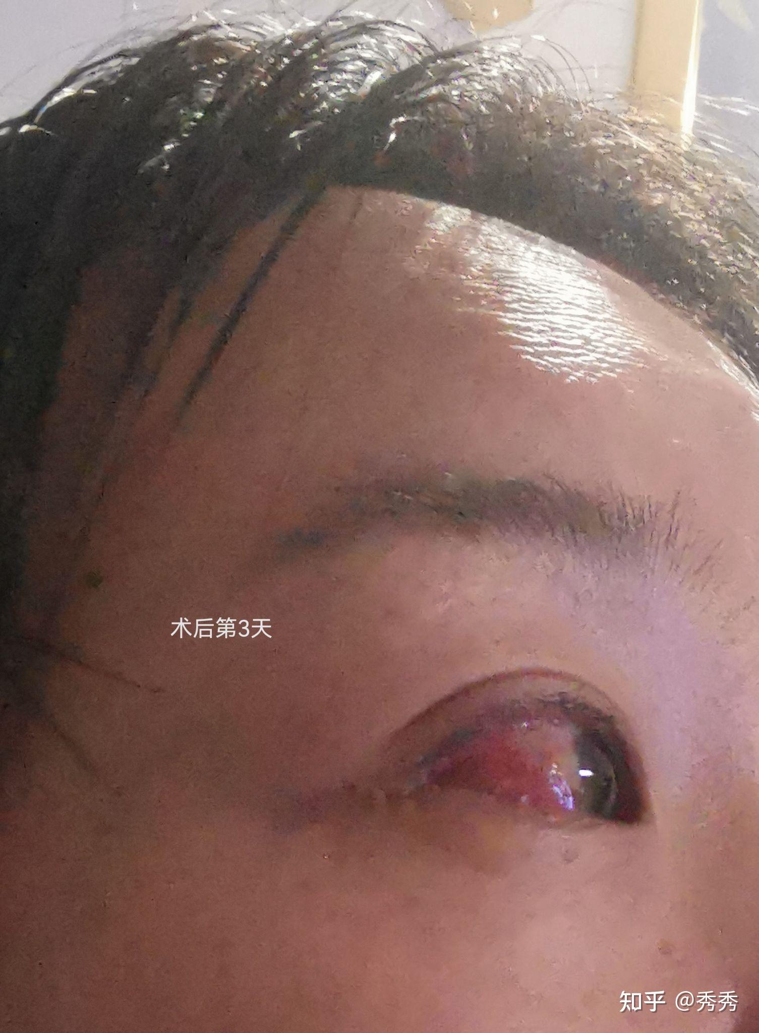 眼结膜囊肿手术前后对照