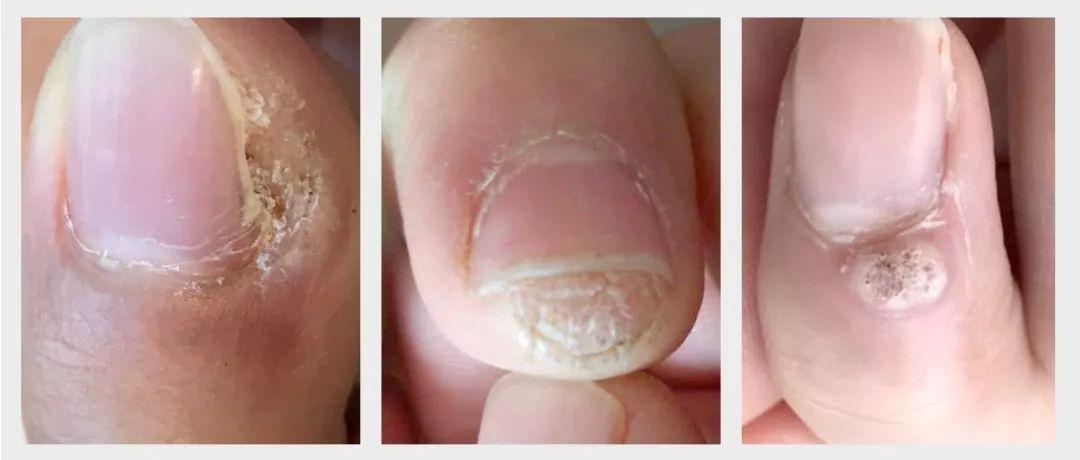 孙叔公干货|540秒,掌握甲周疣核心,节省43%的钱