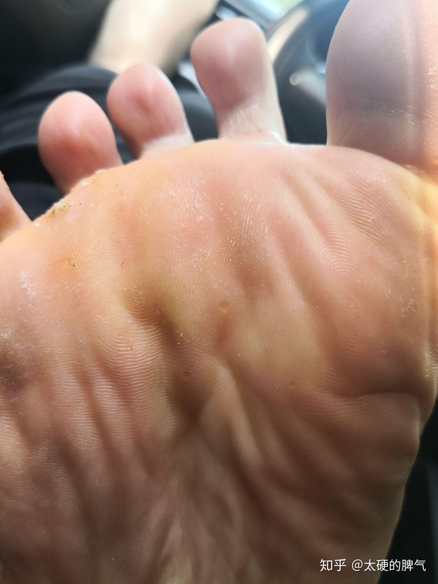 可恶的趾疣看我战胜你