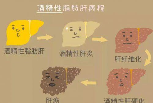 对肝病有一定了解的都知道,酒精肝是酒精性脂肪肝的简称.