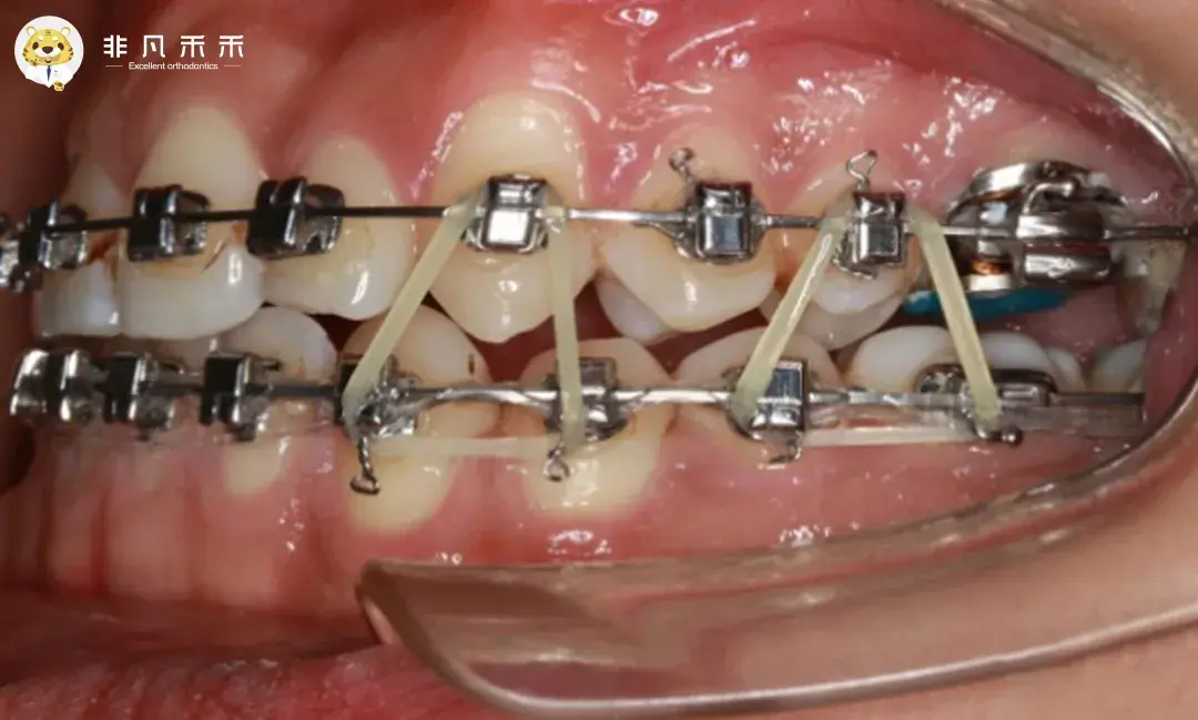 正畸二类牵引图片图片