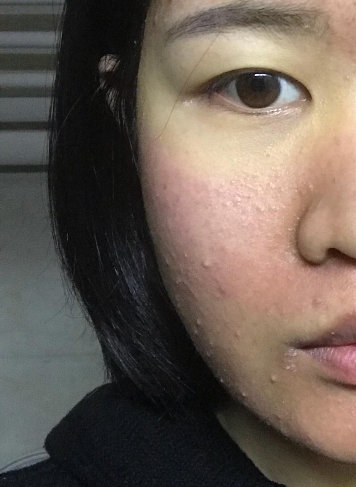 光动力治疗痤疮的效果好吗?