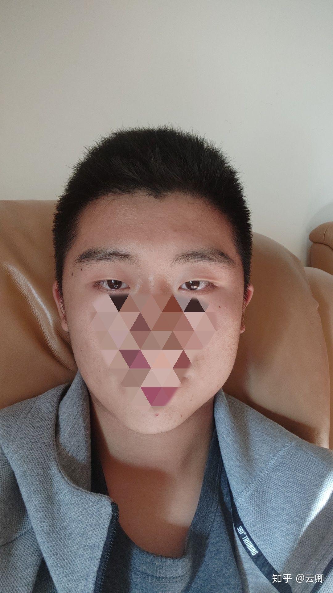 为什么很多人都有左右脸,以及大小眼,甚至有的