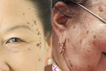 如何祛除脸上手上的老年斑给您一条明路
