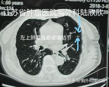 磨玻璃结节故事10 一个2厘米的恶性混合磨玻璃结节两年半来几乎不增大 知乎