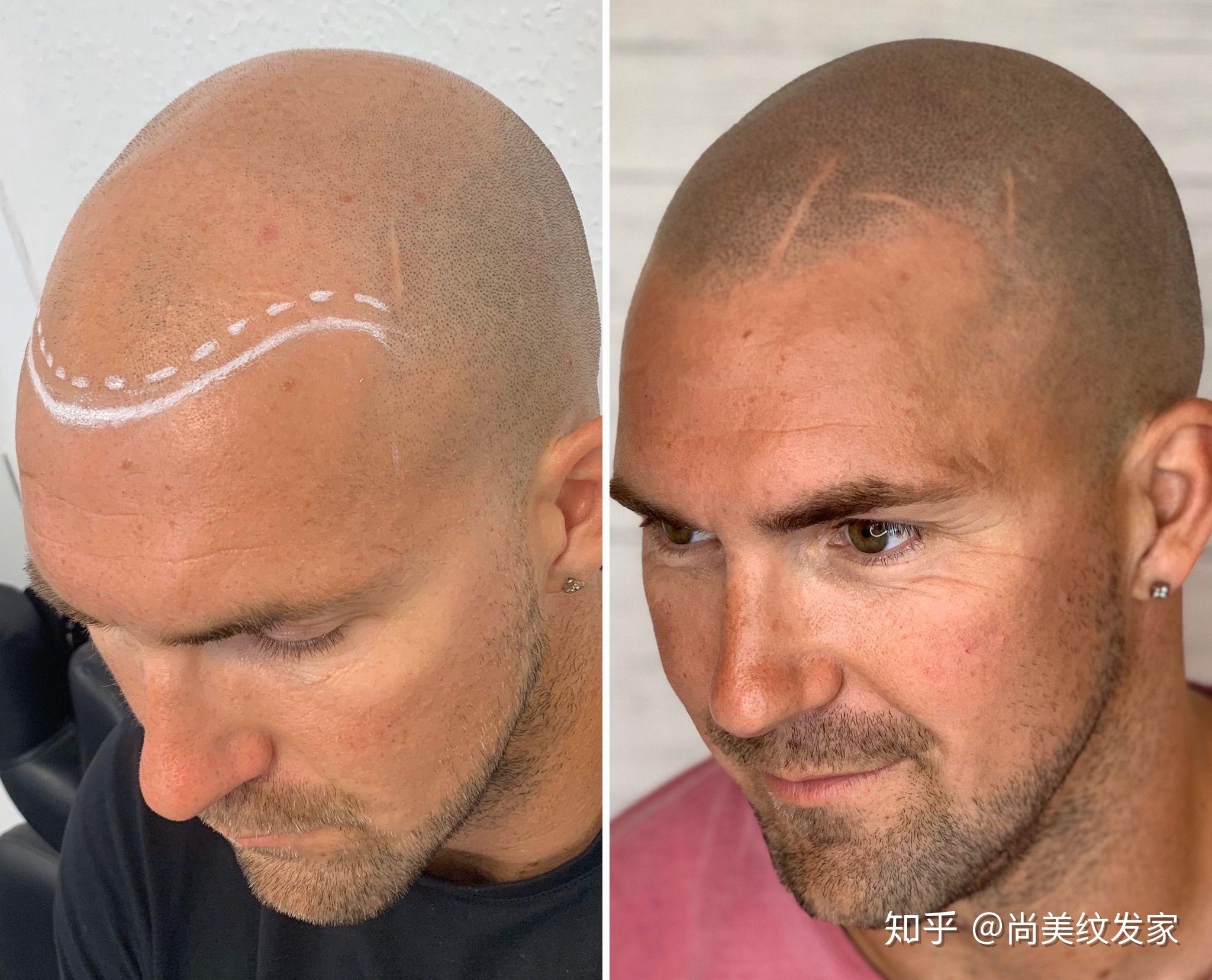 纹发不是制止脱发,而是一种头皮伪装的新兴技术,让