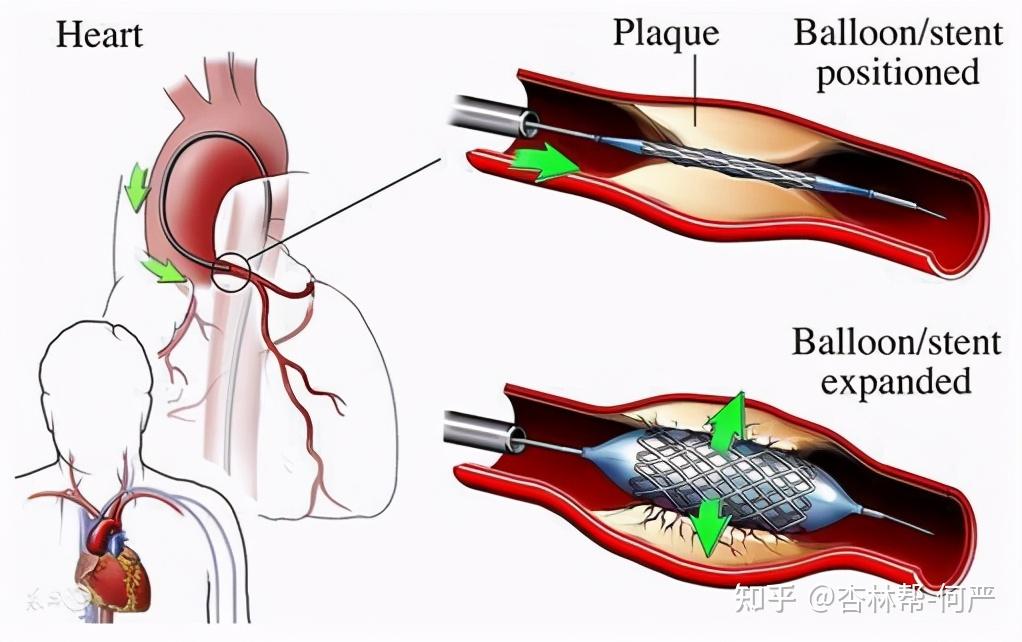 导入球囊,扩张冠状动脉的狭窄处,然后植入支架,把病变部位的冠脉撑