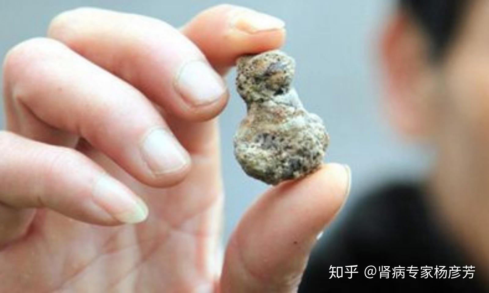 自我检测肾结石发病之前有预兆