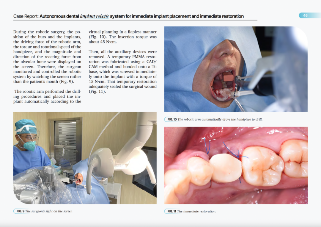 最新学术成就自主式种植牙机器人系统病例报告