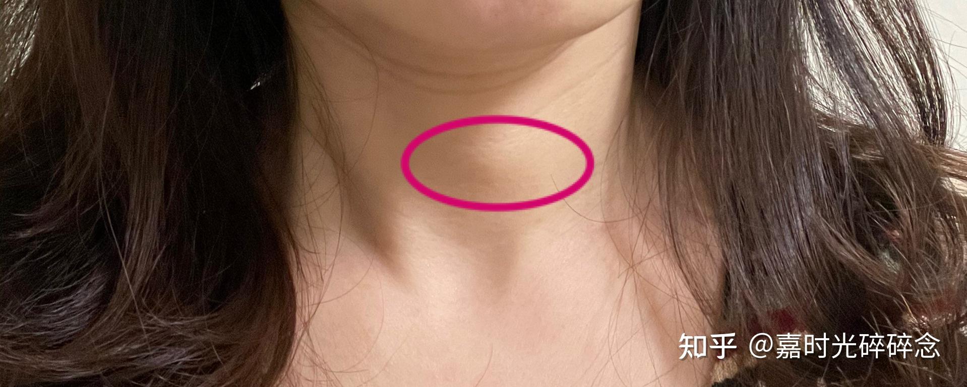 正常甲状腺脖子的照片图片