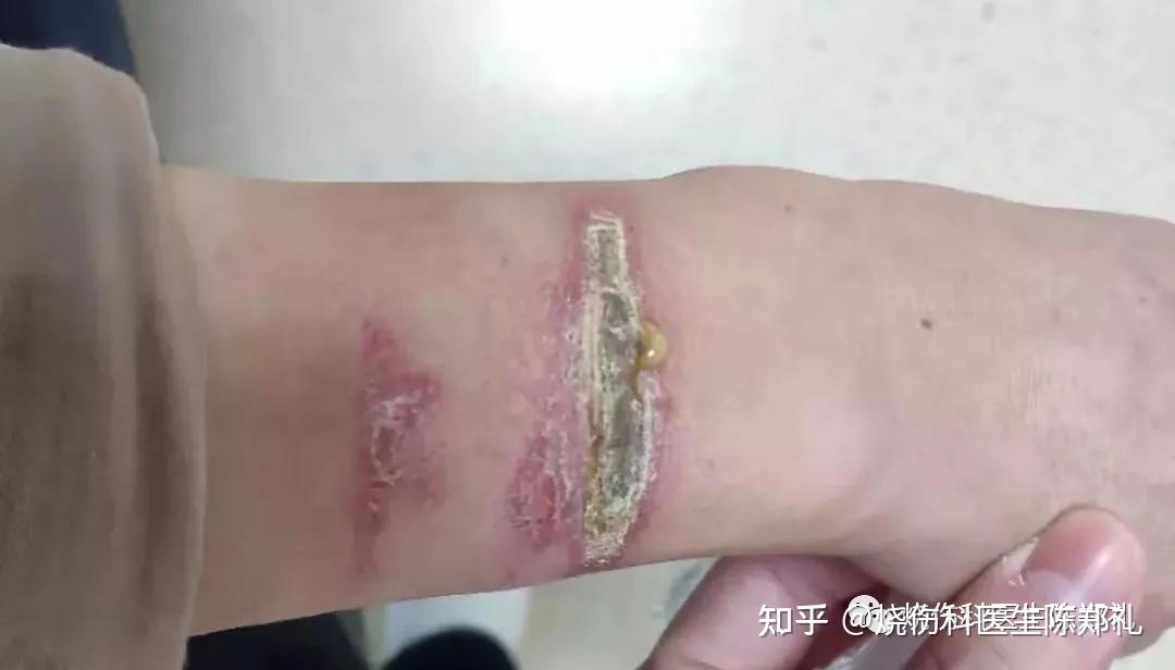 为什么伤口必须要碰水? - 知乎