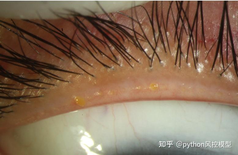 干眼睑缘炎综合征（DEBS）：睑缘炎，生物膜与干眼症 - 知乎