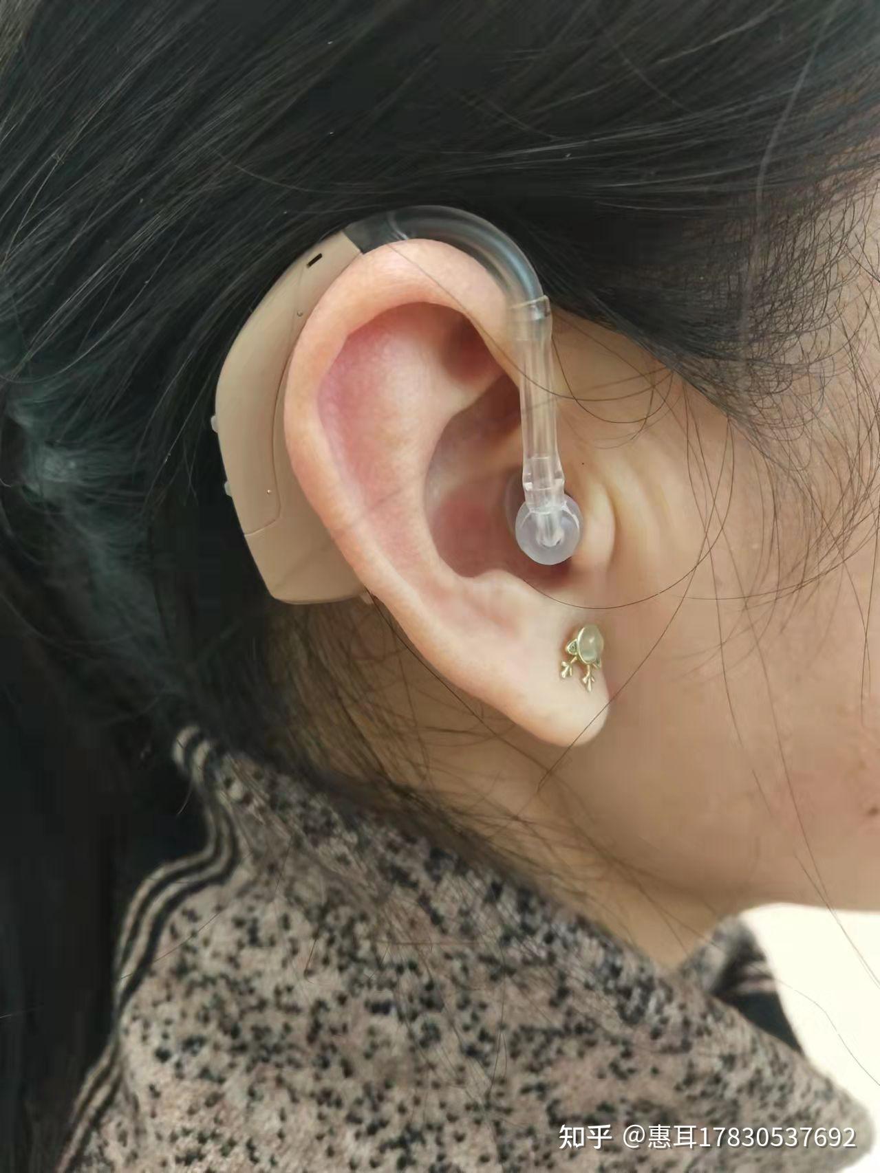 合川助听器—从模拟式助听器到数字化助听器佩戴!