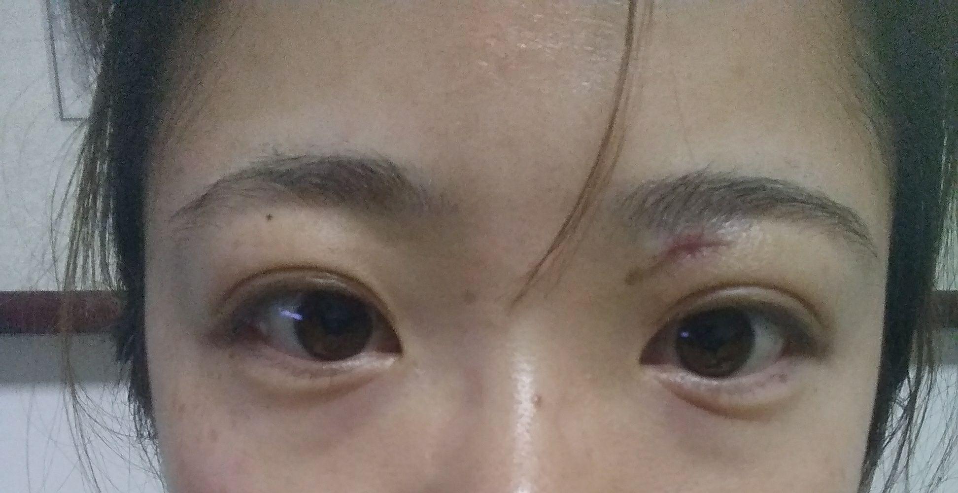 手术切痣是一种怎样的体验?