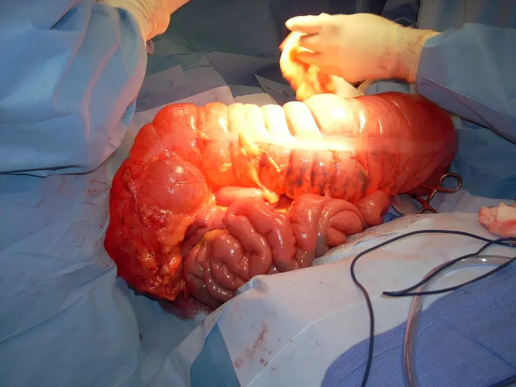 此外,巨大的粪球还会阻止血液的供给,让裂缝难以愈合,伤口继续恶化.