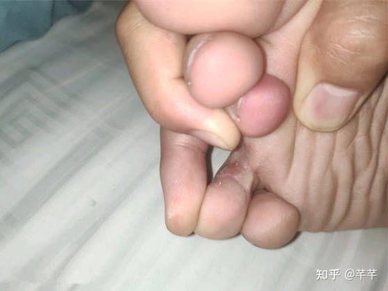 脚气怎么治喜欢抠脚被发现尴尬死了