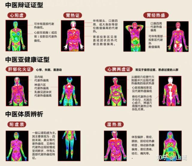 借助红外热成像技术,通过分析人体的体表经络温度规律,研究发现不寐证