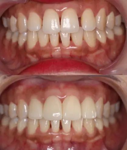 牙缝大的症状,是选择牙齿矫正,还是牙齿贴面比较好?