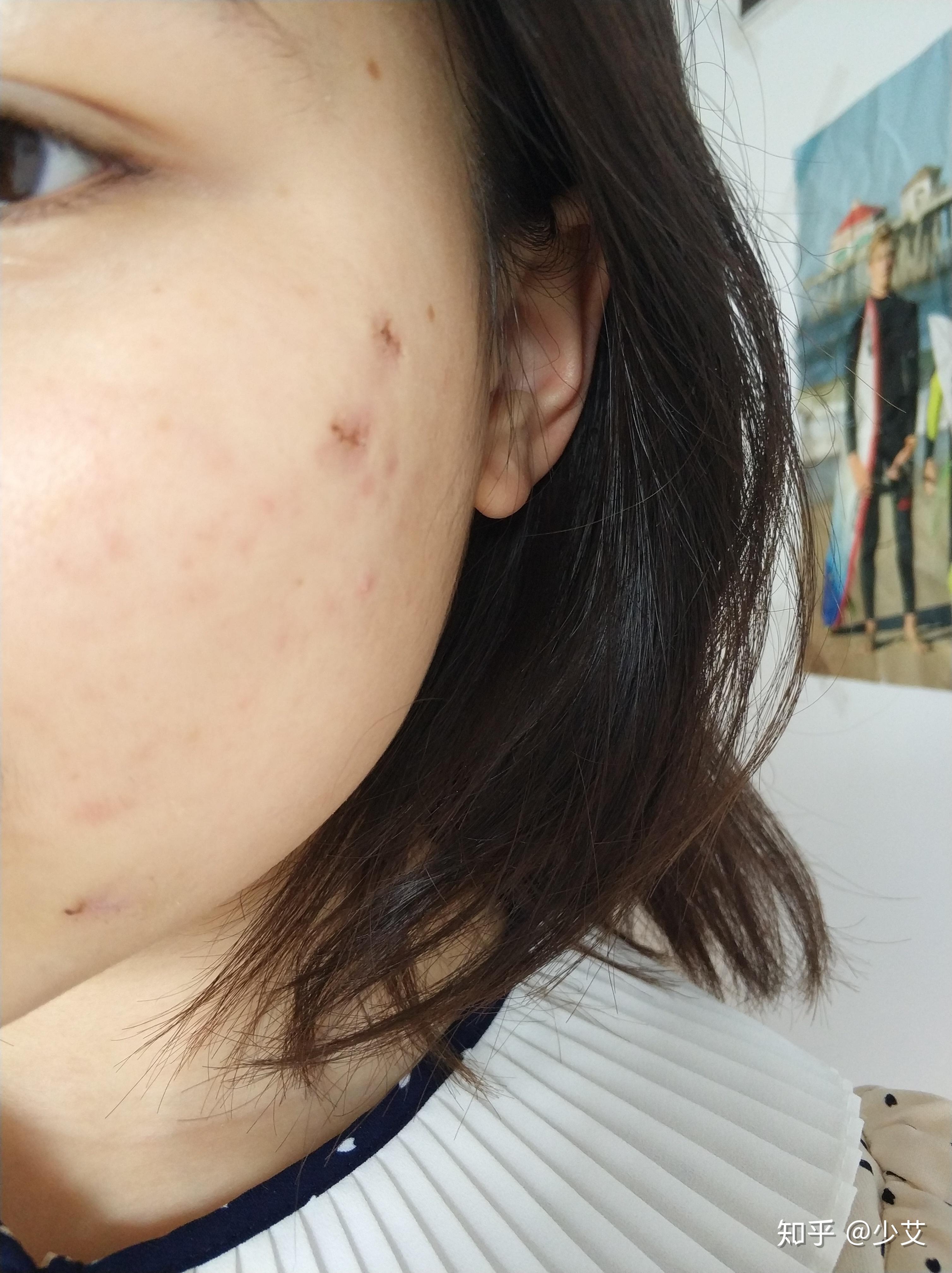 一鼓作气去医院手术切除3颗面部黑色素痣