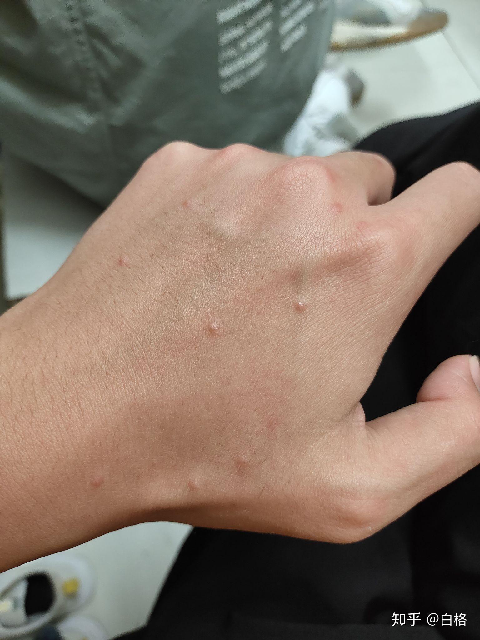 手上起了小包 像蚊子咬的一样? - 知乎