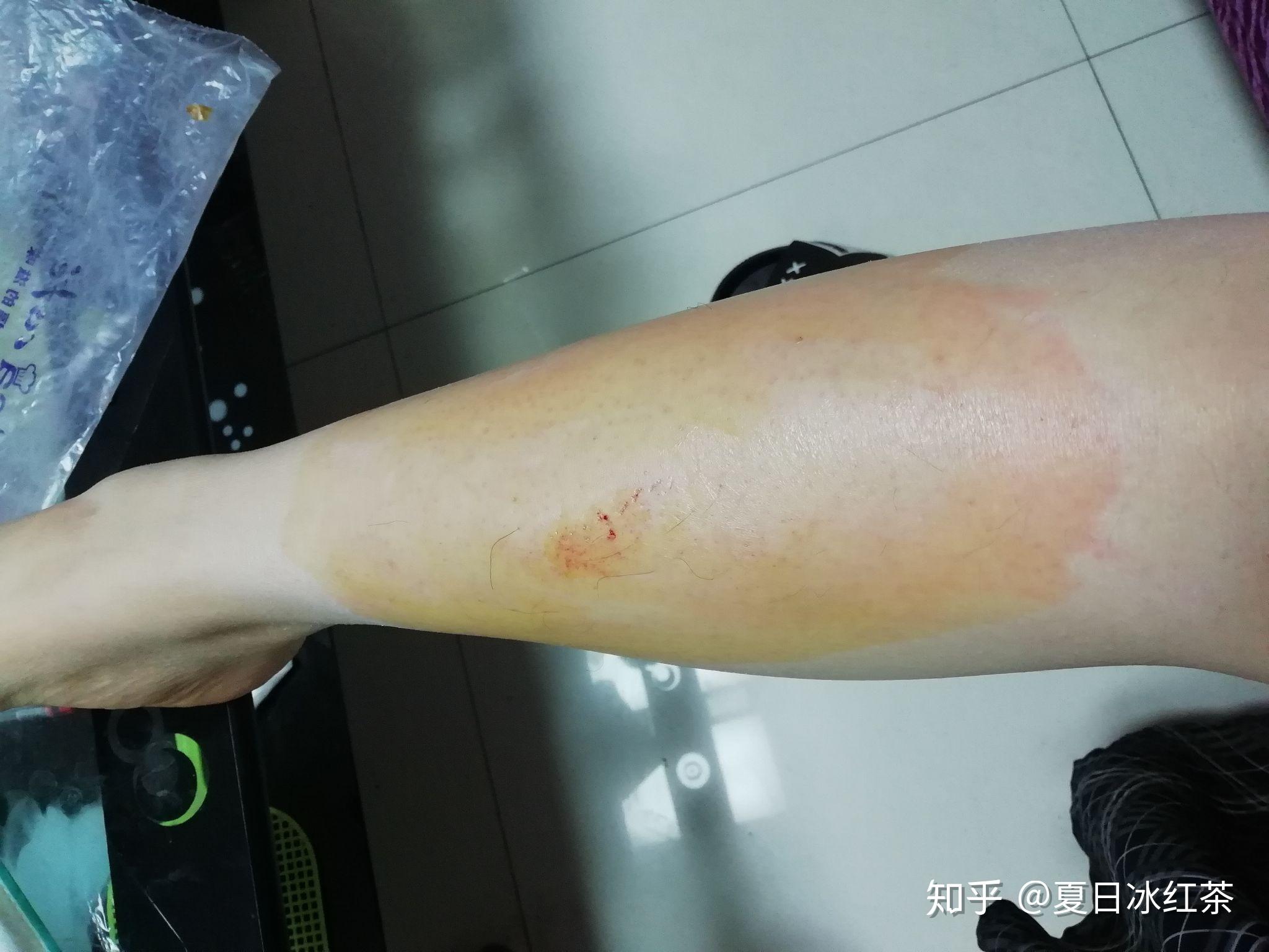 现在感觉腿肿了