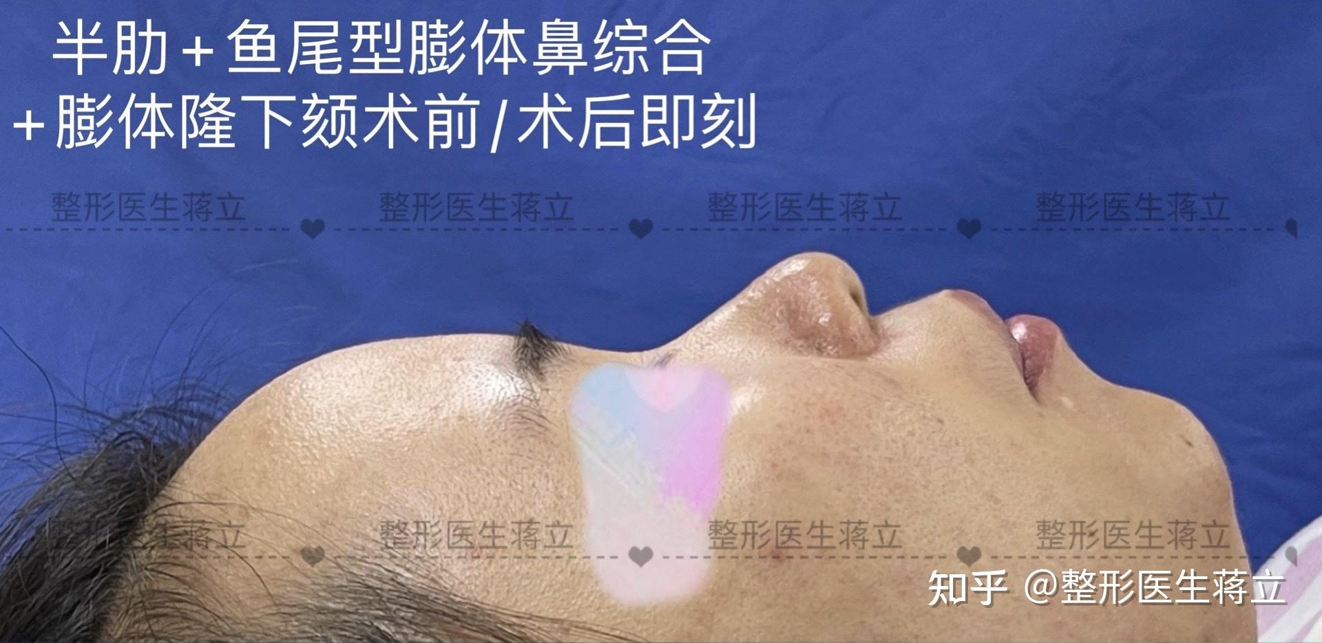 面中凹,嘴巴凸,下巴收缩,皮肤偏厚,毛孔明显,正面鼻头圆钝,鼻翼宽,侧面想整体加高,拉面中 - 知乎