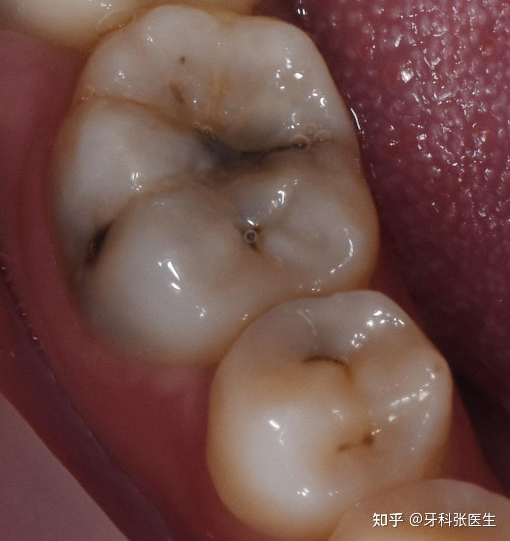 很多人都会有这样的经历,吃糖果或巧克力时,牙齿会突然很酸痛,从而不