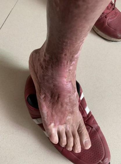 烧伤疤痕按摩减少疤痕生成重要手段