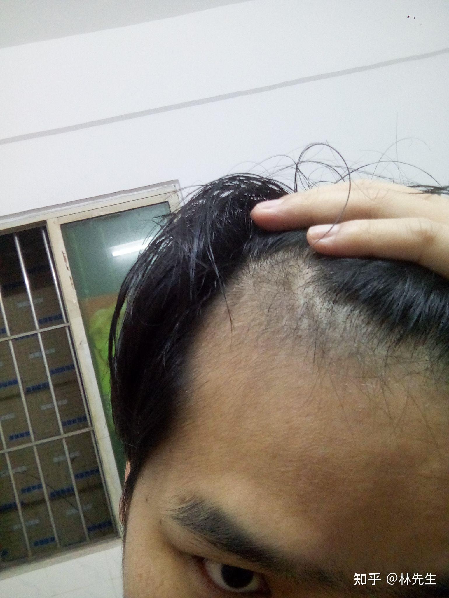 治疗m型脱发,用米诺加非那第二个月 