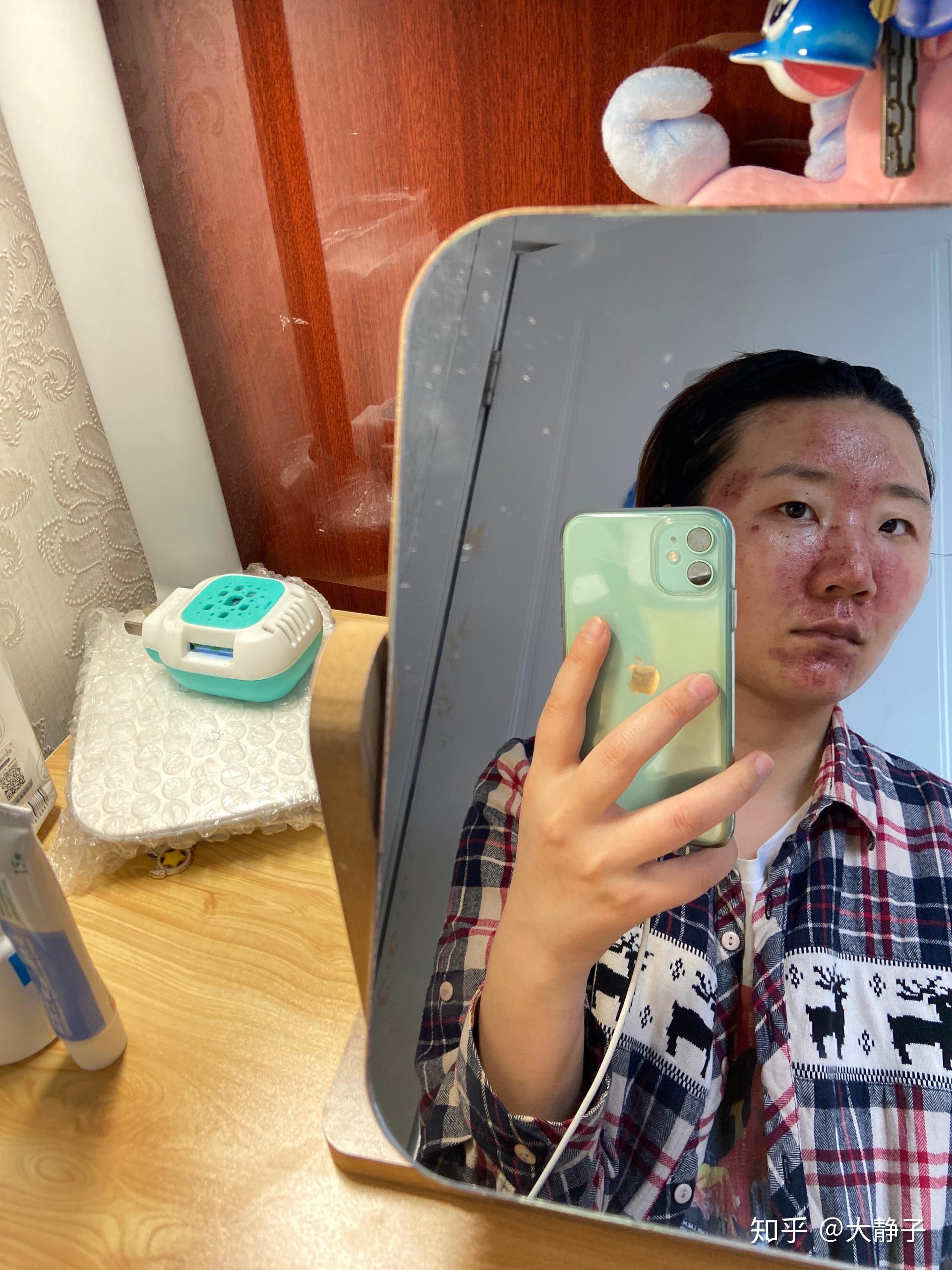 天津长征医院二氧化碳激光治痘坑