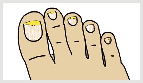 孙叔公漫谈因为甲菌灰指甲我自卑了十年