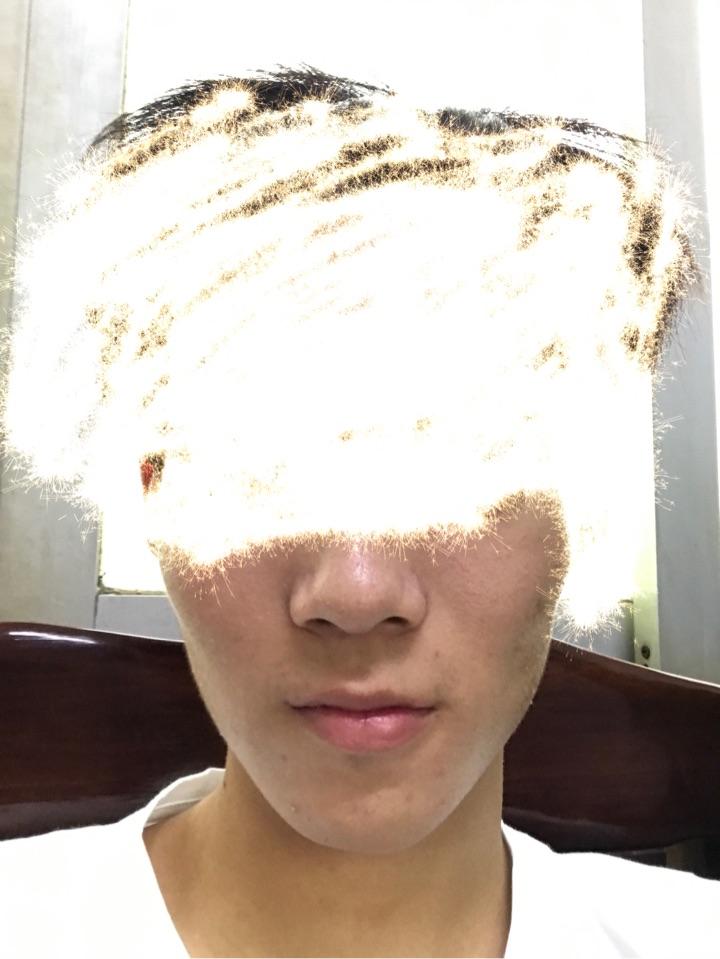 左右脸不对称,有什么好的解决办法吗?