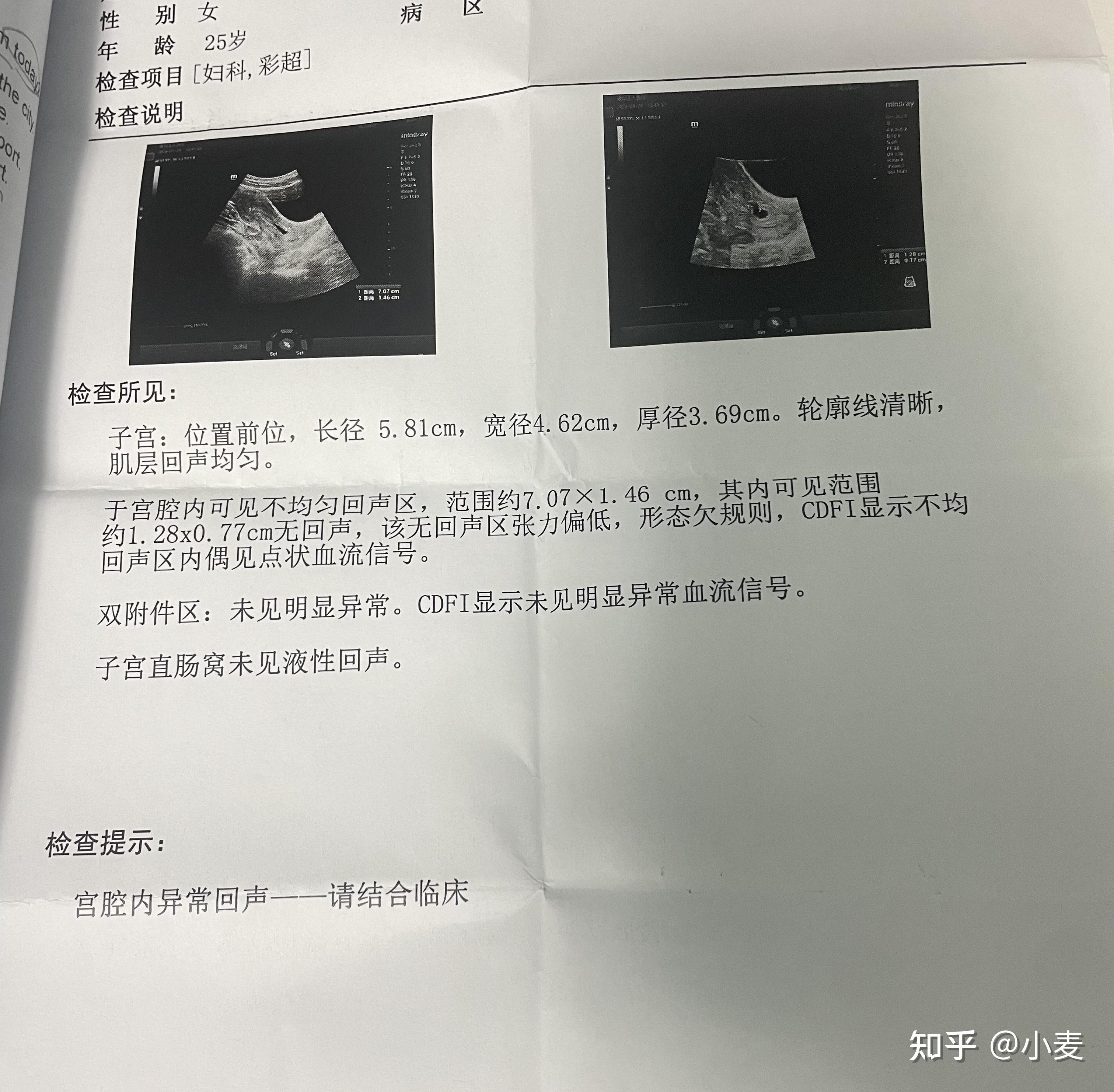 药流孕囊不掉 7cm残留 无清宫