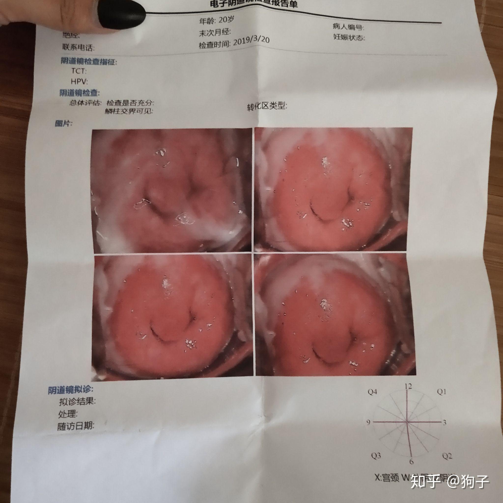 宫颈糜烂激光手术图片图片