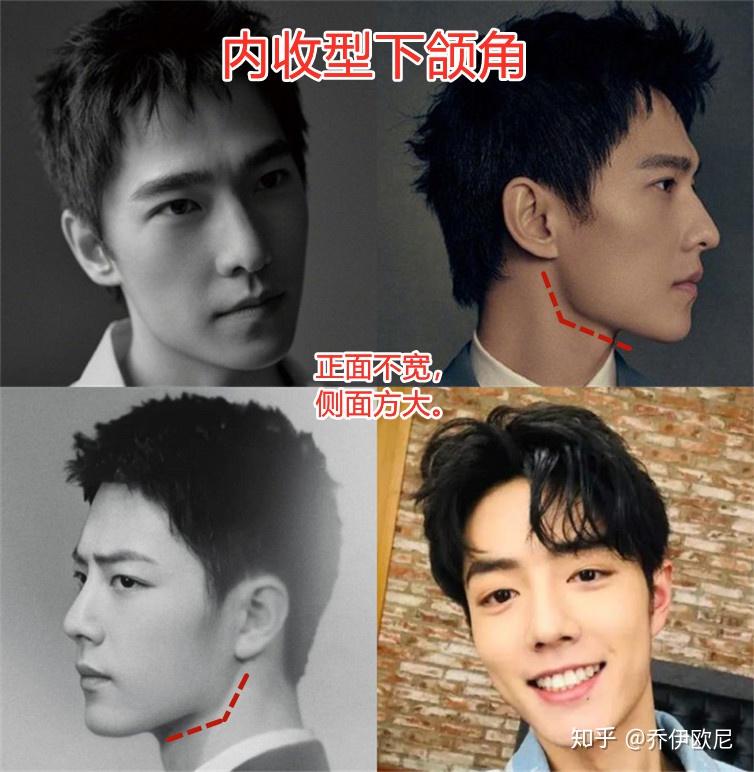 磨骨削骨手术下颌角的l型截骨u型截骨和超长曲线截骨有什么区别怎么选