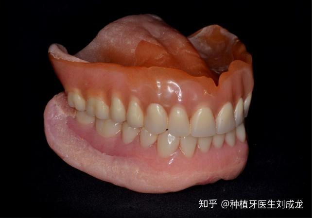 郑州瑞士iti种植牙:种植导板下无牙颌种植修复,恢复全口牙 - 知乎