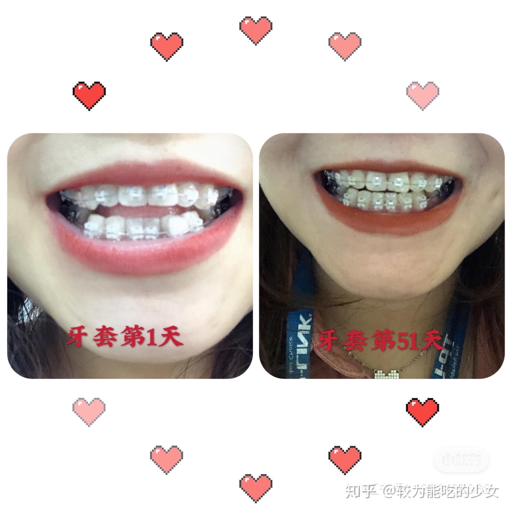 戴牙套3个多月了,花了11000,大家矫正花了多少钱呢?