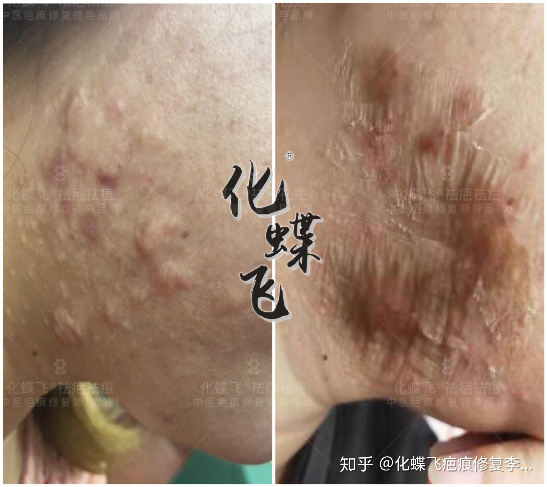 痘疤又叫痤疮结节或疤痕疙瘩