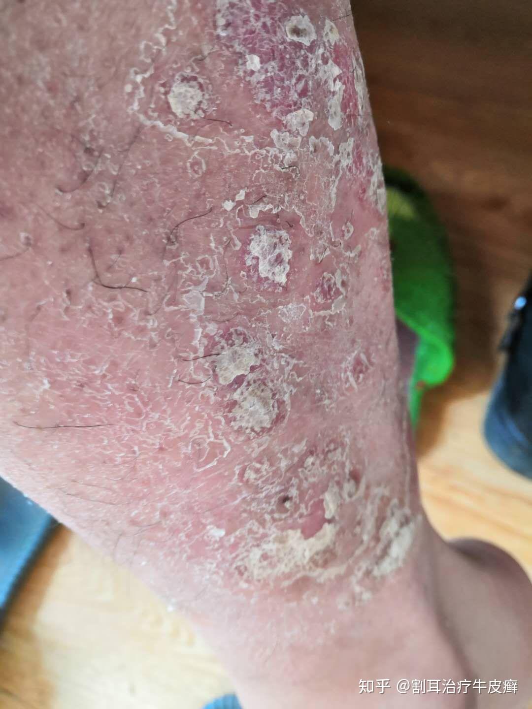 西安治疗牛皮癣医院动态解读