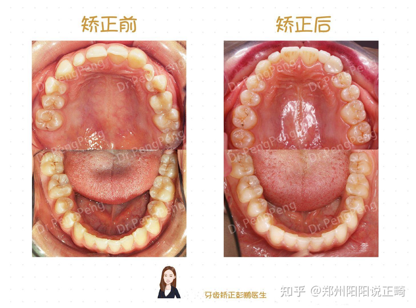 鄭州隱適美深覆頜牙齒散隙下巴後縮矯正案例