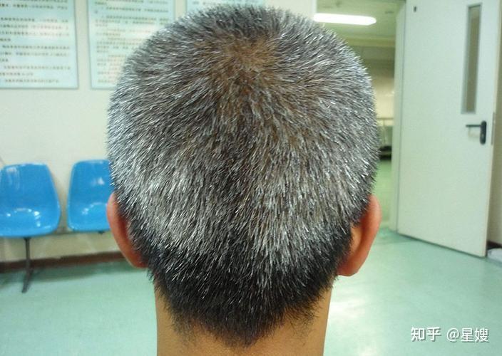 少年白头?未老先衰?墨飞国际白发护理为你揭露白发的生成原因 - 知乎