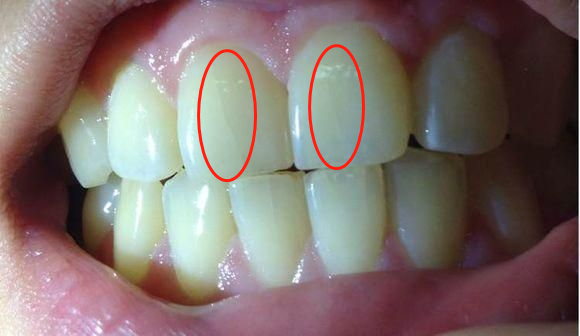 解答牙齿上有裂纹是怎么回事