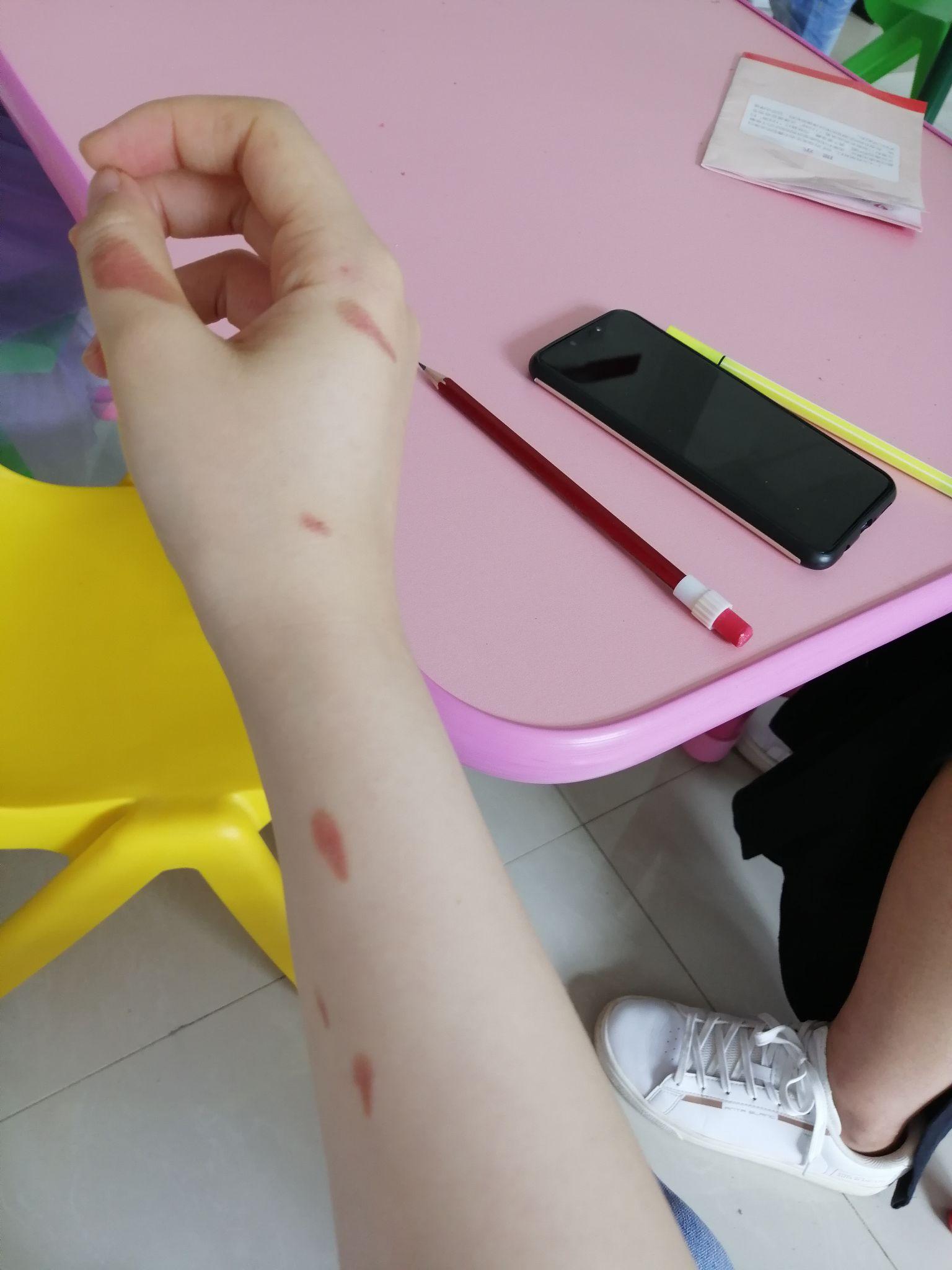 烫伤怎么样处理不会留疤? - 知乎