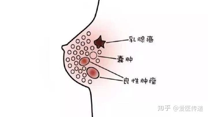 乳腺囊肿有什么症状图片