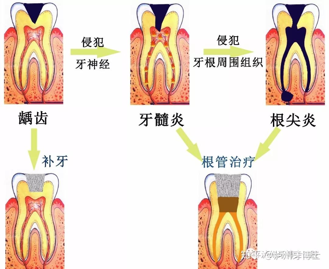 小洞不補大洞吃苦蛀牙你還在拖嗎瀘州牙博士口腔