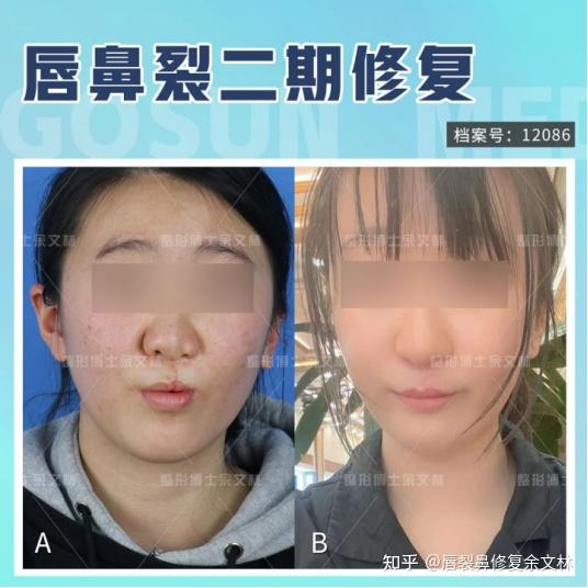 我有先天性兔唇,会影响我找工作吗? - 知乎