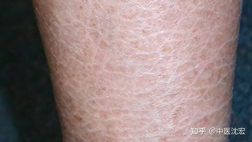桂枝茯苓丸长期服用，身体会出现什么变化，中医告诉你！ 知乎