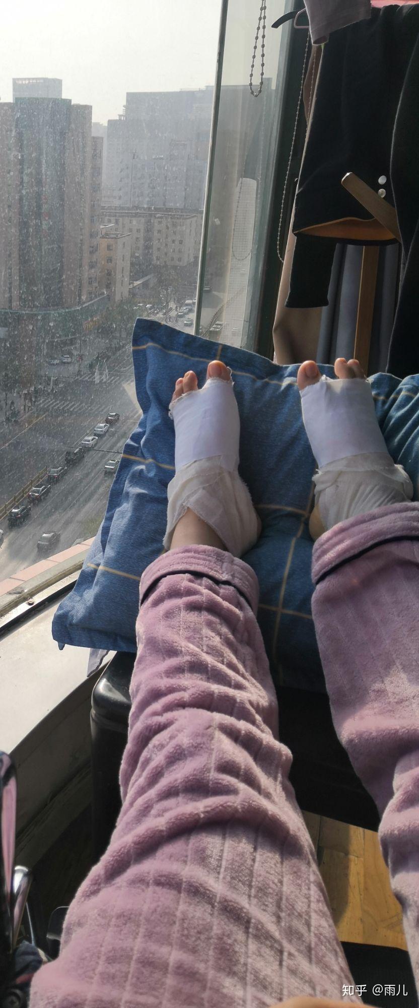 脚现在还没拆纱布,现在脚有点疼不想打字了,后面再更.下面是我的图.