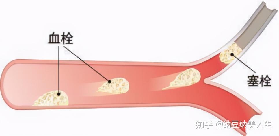 你知道血栓是怎樣形成的嗎