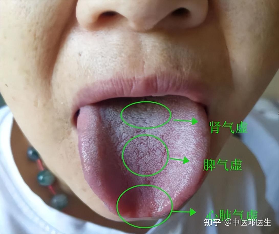 舌腹粘液囊肿如何痊愈不复发？ - 知乎